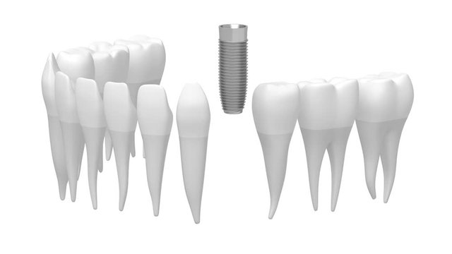 3D dental implant/ tooth implant animation - on white background.