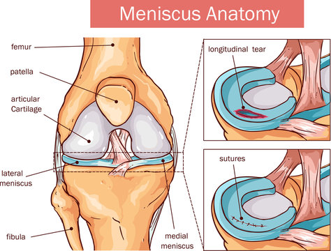vector illustration of a Meniscus tear and surgery