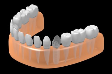 Dental implant/ tooth implant