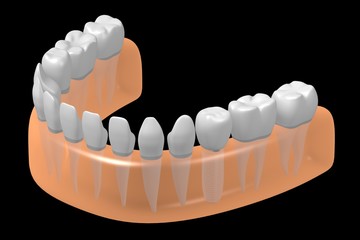 Dental implant/ tooth implant