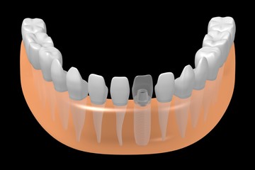 Dental implant/ tooth implant