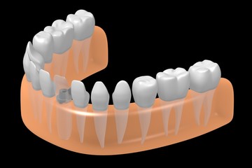 Dental implant/ tooth implant