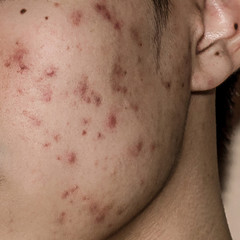 Close up of Acne on the skin, Acne on the face caused by Hormone, Acne inflammation and Wrinkle on...
