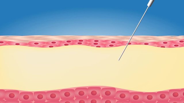 Liposuction before and after , fat , diet , surgery