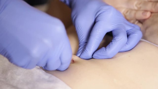 Operation to install navel piercing. doctor makes navel puncture