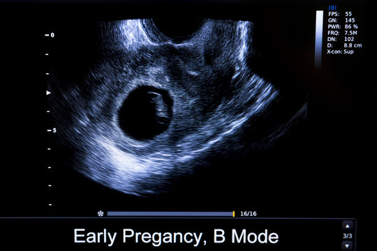 Colourful image of pregnancy ultrasound monitor