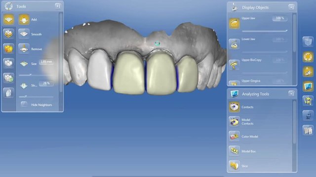 Creating and designing Porcelain Veneer installation Procedure, Dental Veneers 3D animation