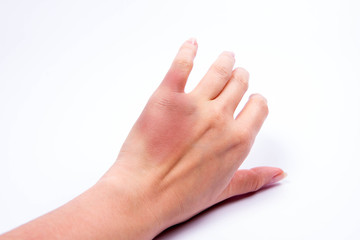 Woman's hand with a bruise