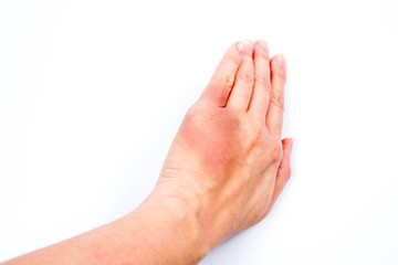 Woman's hand with a bruise