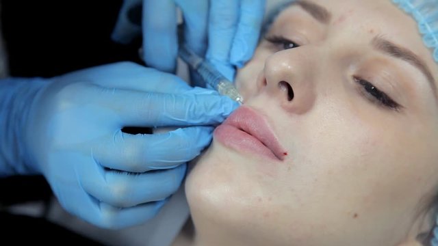 The doctor-cosmetologist introduces Botox into the girl's lips to enlarge them. Lip augmentation in the clinic