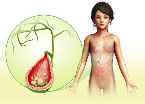 Child with gallstones, illustration