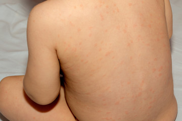 Chicken pox / varicella