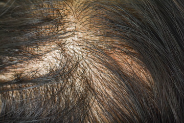 thin hair in women