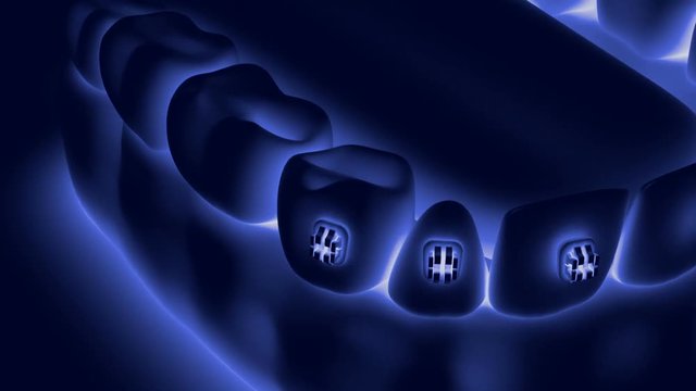 Animation dental brackets