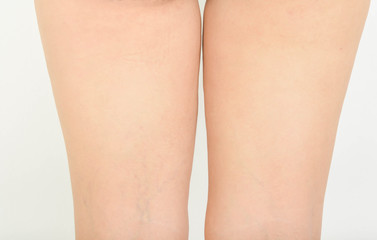 cellulite in a leg of women