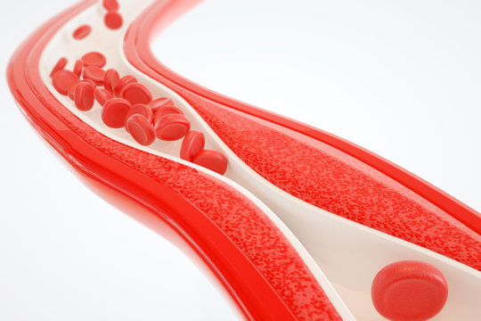 Angioplasty without stent placement- 3D rendering