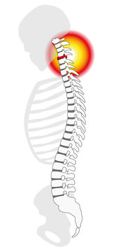 Neck pain - spinal disc herniation or prolapse at a human cervical vertebrae - profile view. Isolated vector illustration on white background.