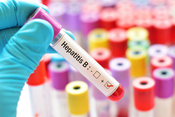 Blood sample with hepatitis B virus (HBV) positive