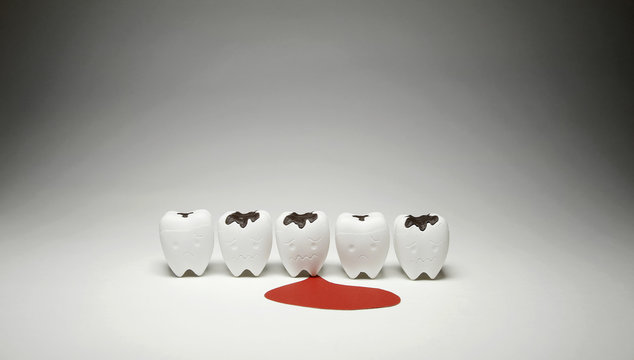 Model of Decayed tooth and Scurvy Teeth Bleeding for Dental Unhealthy