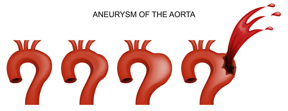 aneurysm of the aorta. cardiology