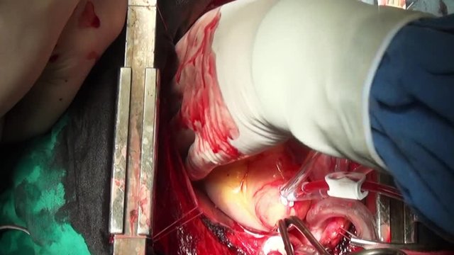 Heart of Man surgery professional doctor hands unique video close up in clinic. Struggle for life. Operation on live organ of patient in hospital.