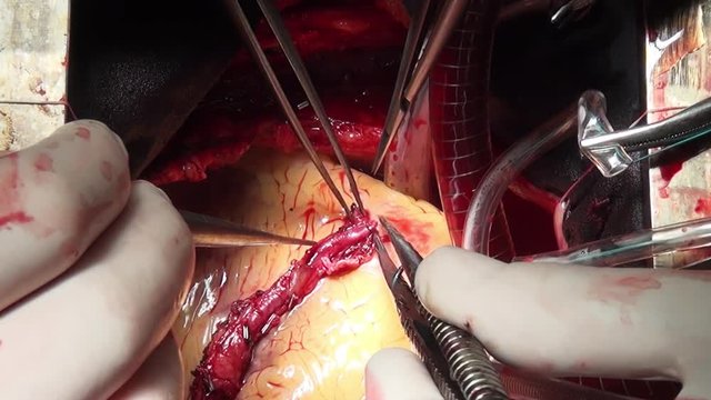 Heart of Man surgery professional doctor hands unique video close up in clinic. Struggle for life. Operation on live organ of patient in hospital.