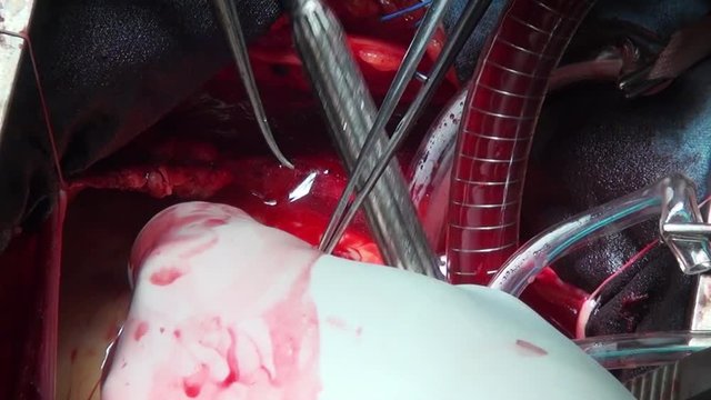 Heart surgery professional doctor hands unique macro video in clinic. Struggle for life. Operation on live organ of patient in hospital.