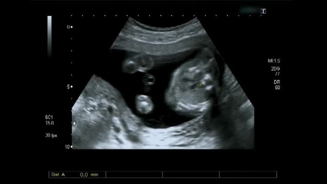 Ultrasonography of Fetus inside woman's womb, heart ecography