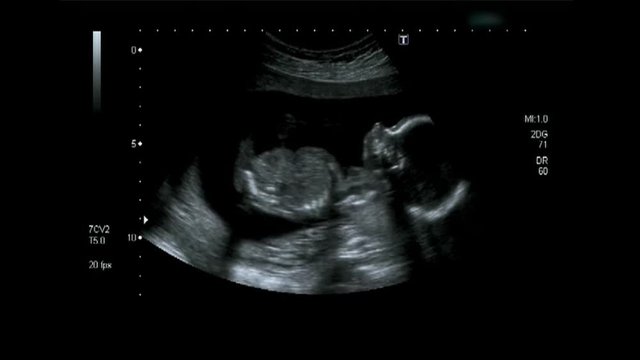 Obstetric Ultrasonography Ultrasound Echography of a fourth month fetus body.