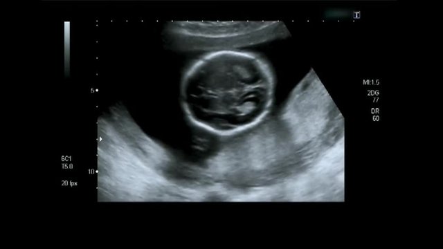 Baby ultrasound.