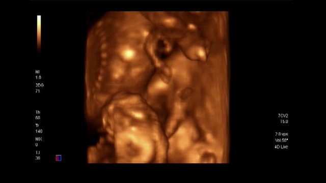 3D ultrasonography of third month fetus body in mother's womb.