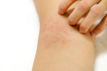Women's hands are scratching allergy to red rash on white background