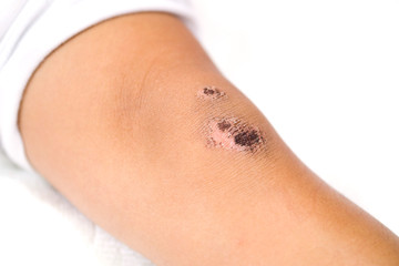Fototapeta premium wound scab of a child's knee on a white background