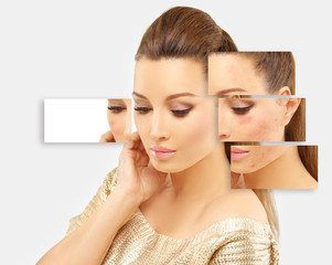 Post-Acne Marks /Treating Acne Scars
