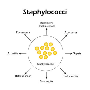 Staphylococci. Staphylococcus aureus causes diseases. Infographics. Vector illustration