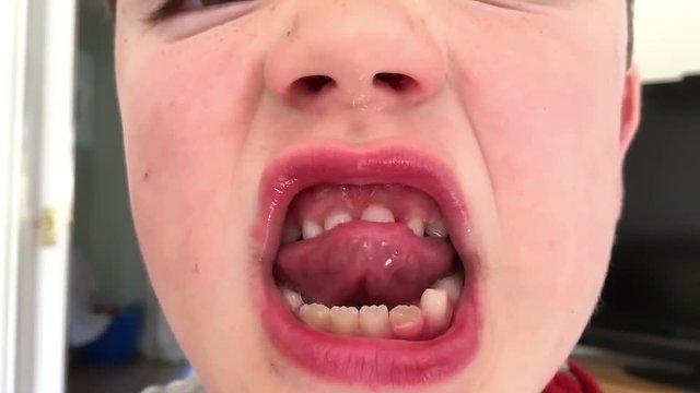 Young boy wobbling a loose tooth using his tongue 
