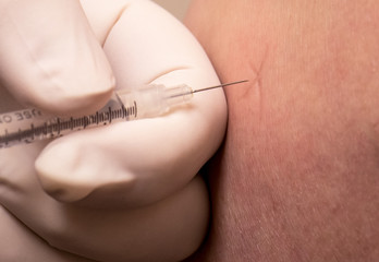 prp injection into caucasian knee 