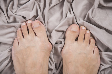 Hallux valgus, bunion in a leg on a beige soft background