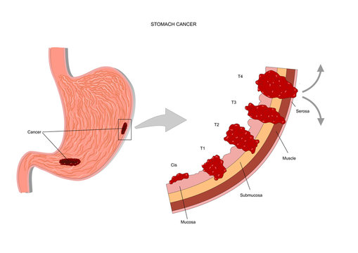 Stomach Cancer, Or Gastric Cancer, In Its Various Stages