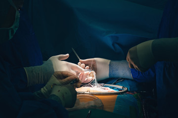 Team of surgeons minimally invasive aortic valve surgery replacement with sutures placed of each...