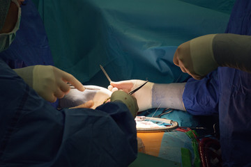 Team of surgeons minimally invasive aortic valve surgery replacement with sutures placed of each...