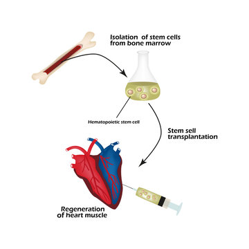 Stem cells from bone marrow is used to regenerate the cardiac muscle. Infographics. Vector illustration