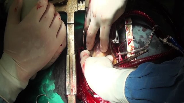 Heart of Man surgery professional doctor hands unique video close up in clinic. Struggle for life. Operation on live organ of patient in hospital.