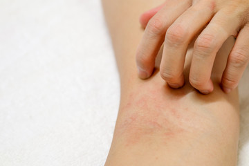 Women's hands are scratching allergy to red rash on white background