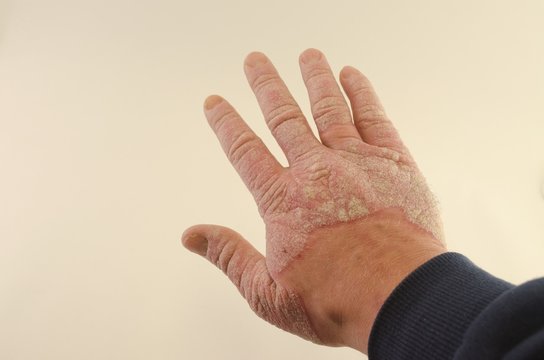 exacerbation of psoriasis in the hands