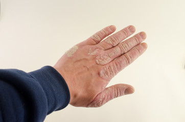 exacerbation of psoriasis in the hands