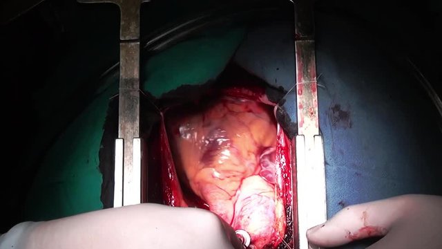 Heart surgery professional doctor hands unique macro video close up in clinic. Struggle for life. Operation on live organ of patient in hospital.