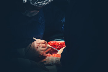 Surgeon hands with white sterile gloves operate with an electric scalpel or cauter electrosurgical,...