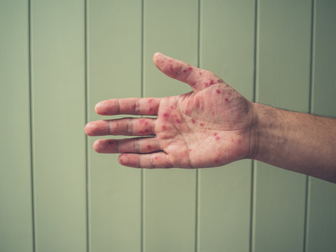 Young man with hand foot and mouth disease