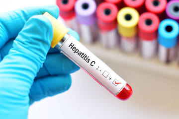 Hepatitis C virus testing positive